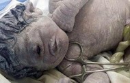 Baby born with one eye in the middle of his forehead and no nose in Egypt