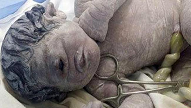 Baby born with one eye in the middle of his forehead and no nose in Egypt