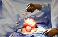 The rising scourge of fibroid in Nigeria