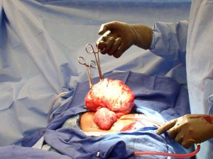The rising scourge of fibroid in Nigeria