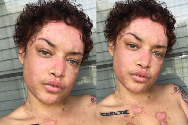 Heard about disease called lupus? Young woman opens up about her lupus battle