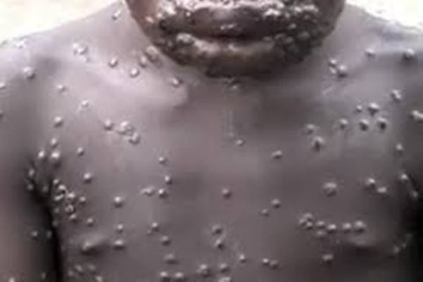 FG denies deliberately injecting monkey pox in persons