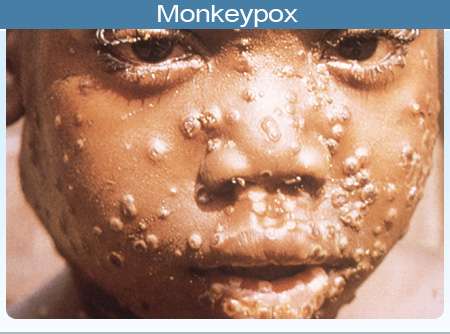 Monkey pox spreads to Lagos, 5 other states