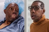 First African American man to get a face transplant is ‘on the road to recovery’