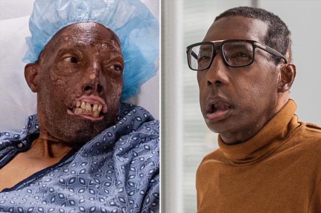 First African American man to get a face transplant is ‘on the road to recovery’
